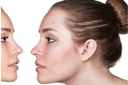 痘痘長在嘴角周圍是怎么一回事，女性清痘只需三招