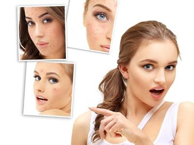 痘痘長在嘴角周圍是怎么一回事，女性清痘只需三招