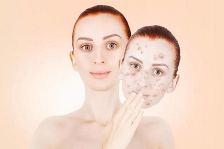 化妝品導致的激素臉，皮膚痤瘡的元兇如何解決