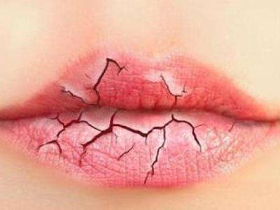 嘴唇干燥脫皮怎么辦? 教你5招輕松應(yīng)對