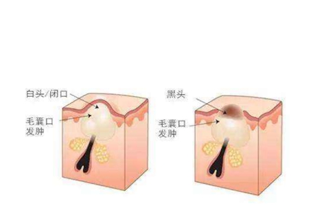 閉口是什么，它會(huì)慢慢自己消失嗎，去除閉口要靠這四招