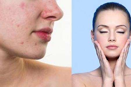 閉口是什么，它會(huì)慢慢自己消失嗎，去除閉口要靠這四招