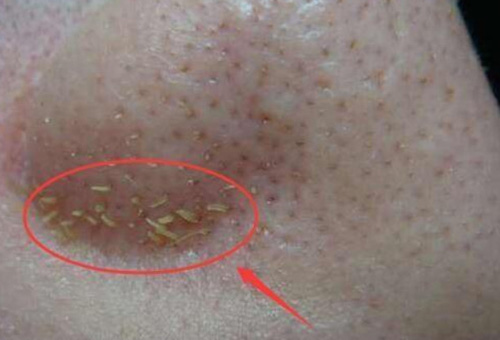 鼻子上擠出來的白色東西是什么？如何正確去除