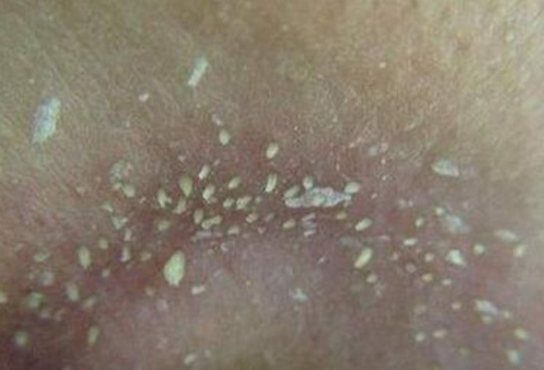 鼻子上擠出來的白色東西是什么？如何正確去除