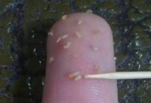 鼻子上擠出來的白色東西是什么？如何正確去除