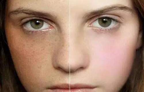 為什么皮膚白的容易長斑？長斑該如何護理？