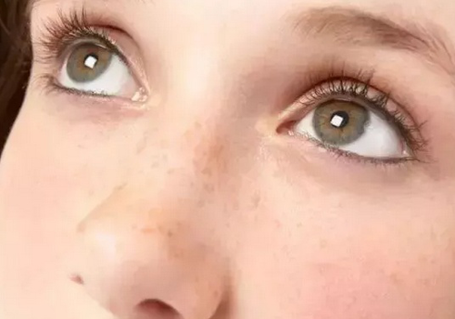 為什么皮膚白的容易長斑？長斑該如何護理？