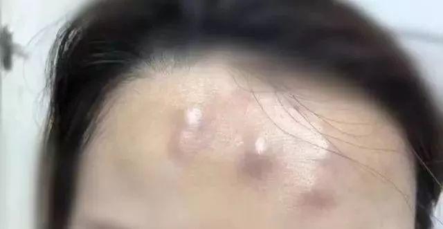 女子注射去皺 額頭竟冒出5個“犄角”