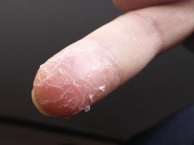 手指脫皮的四個原因，教你快速恢復方法治療手脫皮