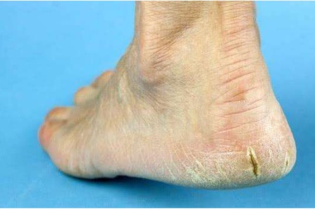 腳后跟干裂起硬皮的原因，女性護理腳部肌膚的正確方法