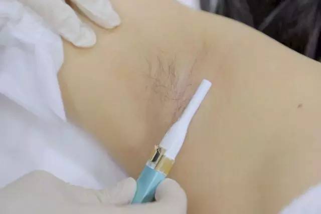 腋下脫毛后出汗多有異味怎么回事?腋下脫毛護(hù)理方法分享