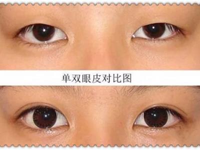雙眼皮貼久了有害嗎？一天貼多久最適宜？