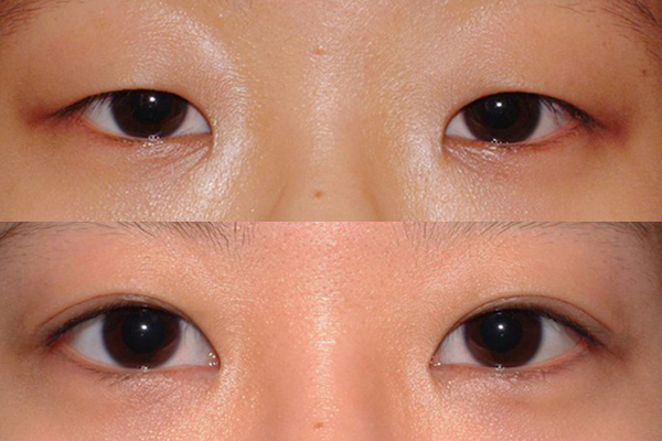 雙眼皮貼什么形狀好用?如何使用?-易網健康<a href=http://www.gyfww.com/jkys/ target=_blank class=infotextkey>養(yǎng)生</a>網 雙眼皮貼什么形狀好用?如何使用?