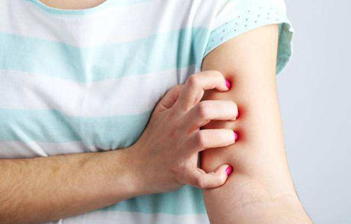 冬季濕疹反復(fù)發(fā)作怎么辦? 做到這6點(diǎn)遠(yuǎn)離濕疹