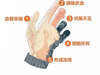 冬天天氣冷長凍瘡怎么辦？6個小妙招教給你
