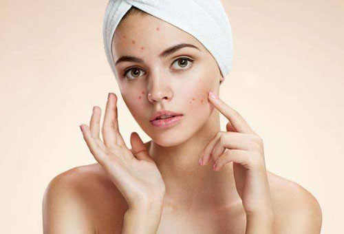 面部頻繁起痘是怎么回事？這4個(gè)原因要注意