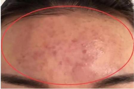 引起額頭長痘的原因，女生做這四件事快速祛痘