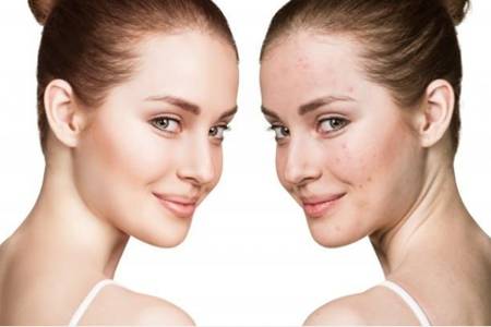 引起額頭長痘的原因，女生做這四件事快速祛痘