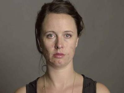 嘴巴周圍長(zhǎng)痘的原因，困擾女生的痘痘問(wèn)題四招解決