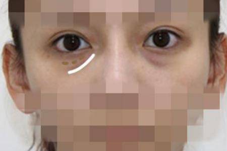 怎樣祛眼袋,讓眼袋消失無蹤的有效妙招-易網健康<a href=http://www.gyfww.com/jkys/ target=_blank class=infotextkey>養生</a>網 怎樣祛眼袋,讓眼袋消失無蹤的有效妙招