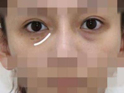 怎樣祛眼袋，讓眼袋消失無蹤的有效妙招