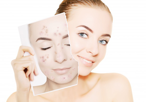 快速去痘印的方法 你需做好這幾點