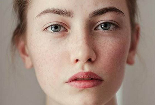 臉上長黃褐斑怎么祛除 3個妙招改善黃褐斑問題