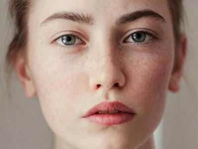 臉上長黃褐斑怎么祛除 3個妙招改善黃褐斑問題