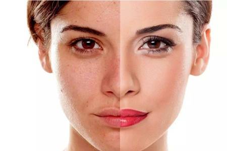 光子嫩膚的危害缺陷，醫美光子嫩膚術后的注意事項