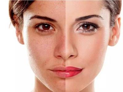 光子嫩膚的危害缺陷，醫(yī)美光子嫩膚術(shù)后的注意事項(xiàng)