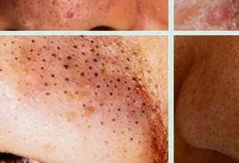 去黑頭粉刺妙招屢試有好效果 什么樣的膚質容易有黑頭-易網健康<a href=http://www.gyfww.com/jkys/ target=_blank class=infotextkey>養生</a>網 去黑頭粉刺妙招屢試有好效果 什么樣的膚質容易有黑頭