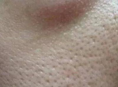 毛孔粗大怎么辦 針對不同情況的毛孔粗大該如何護(hù)膚？
