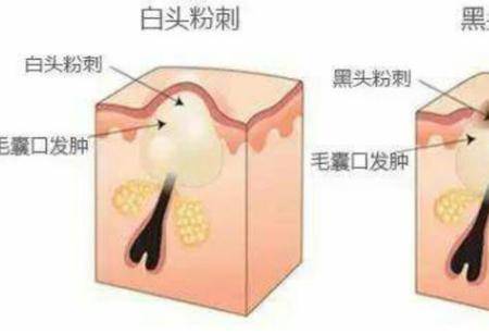 油性皮膚會(huì)有哪些肌膚問題 如何改善油性皮膚問題-易網(wǎng)<a href=http://www.gyfww.com/ target=_blank class=infotextkey>健康養(yǎng)生</a>網(wǎng) 油性皮膚會(huì)有哪些肌膚問題 如何改善油性皮膚問題