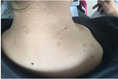 玫瑰糠疹皮膚病怎么引起的，治療方法中忌口這五種食物