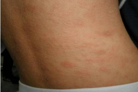 玫瑰糠疹皮膚病怎么引起的，治療方法中忌口這五種食物