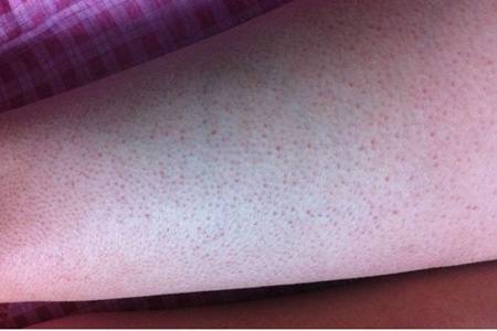 雞皮膚怎么消除?去雞皮膚最有效的方法快速見效-易網<a href=http://www.gyfww.com/ target=_blank class=infotextkey>健康養生</a>網 雞皮膚怎么消除?去雞皮膚最有效的方法快速見效