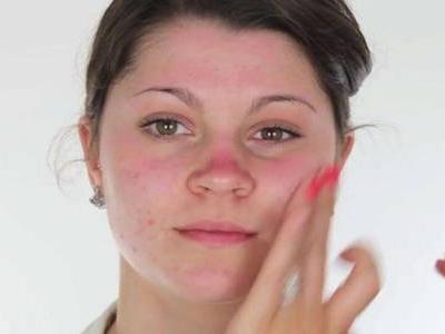 臉上長痘痘如何消除，六個小妙招祛痘簡單快捷