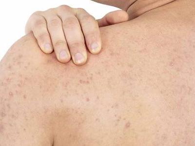 雞皮膚的四大形成原因，如何消除雞皮膚光滑肌膚