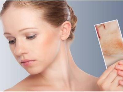 皮膚過敏癥狀有哪些，女性皮膚初期過敏如何治療