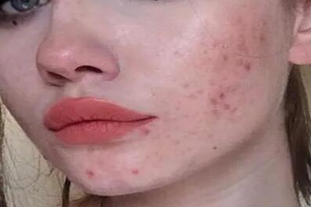 青春痘怎么快速消除？做好這5點或許好得快改善皮膚