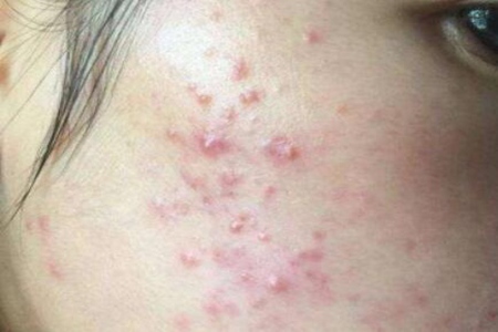 青春痘怎么快速消除？做好這5點或許好得快改善皮膚
