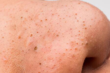 怎么去黑頭？這五個方法幫助你消滅它們