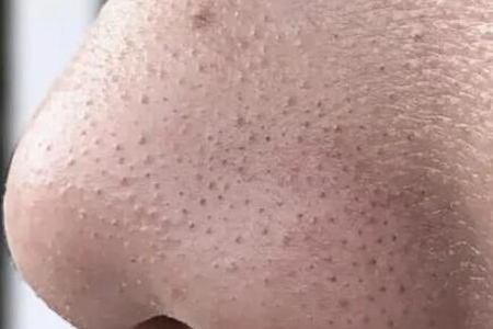 怎么去黑頭？這五個方法幫助你消滅它們