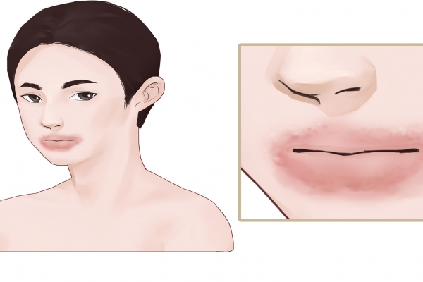 化妝品過敏的癥狀是什么?