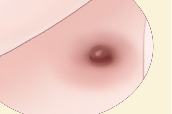 激光去痣后注意事項-易網<a href=http://www.gyfww.com/ target=_blank class=infotextkey>健康養生</a>網 激光去痣后注意事項