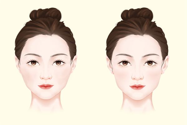 打瘦臉針的注意事項