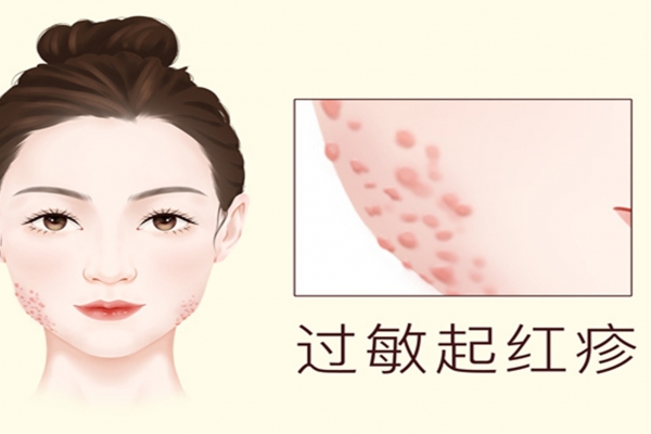 秋季皮膚過敏怎么辦