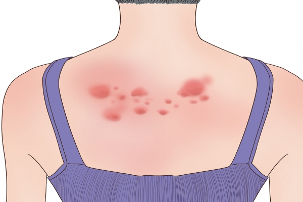 身上很多紅疙瘩、很癢怎么回事-易網<a href=http://www.gyfww.com/ target=_blank class=infotextkey>健康養生</a>網 身上很多紅疙瘩、很癢怎么回事