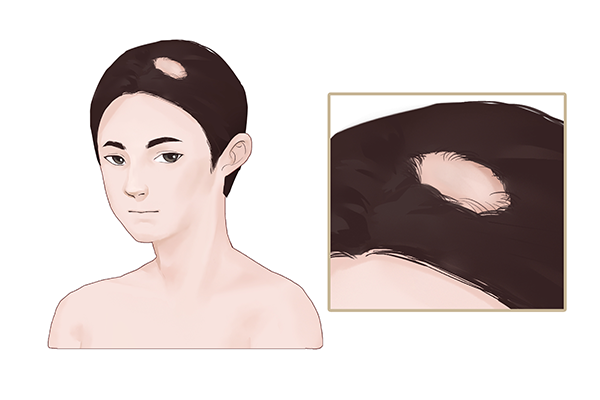 油脂性脫發(fā)該怎么辦