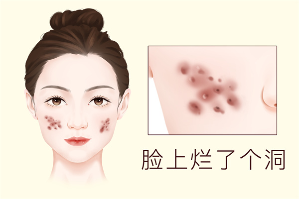 怎么去掉臉上的青春痘